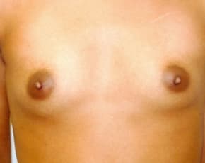 Breast Augmentation Before & After Photos | Associates in Plastic Surgery