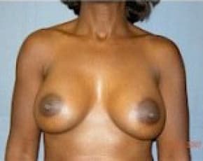 Breast Augmentation Before & After Photos | Associates in Plastic Surgery