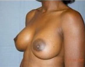 Breast Augmentation Before & After Photos | Associates in Plastic Surgery