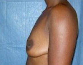 Breast Augmentation Before & After Photos | Associates in Plastic Surgery