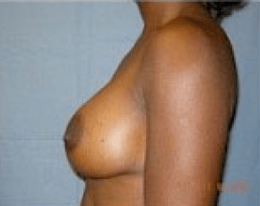 Breast Augmentation Before & After Photos | Associates in Plastic Surgery