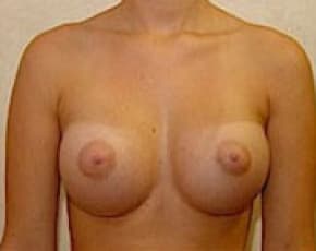 Breast Augmentation Before & After Photos | Associates in Plastic Surgery