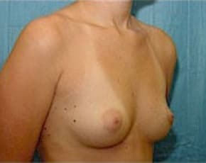 Breast Augmentation Before & After Photos | Associates in Plastic Surgery