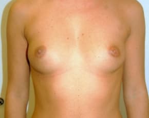 Breast Augmentation Before & After Photos | Associates in Plastic Surgery