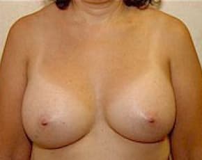 Breast Augmentation Before & After Photos | Associates in Plastic Surgery