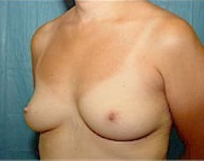 Breast Augmentation Before & After Photos | Associates in Plastic Surgery