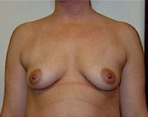 Breast Augmentation Before & After Photos | Associates in Plastic Surgery