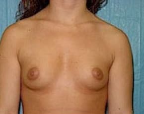 Breast Augmentation Before & After Photos | Associates in Plastic Surgery
