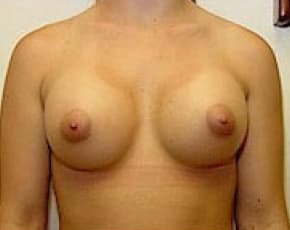 Breast Augmentation Before & After Photos | Associates in Plastic Surgery
