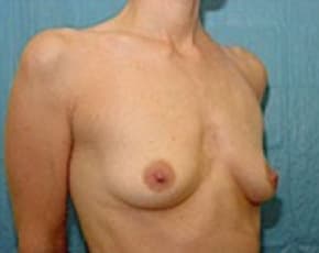 Breast Augmentation Before & After Photos | Associates in Plastic Surgery