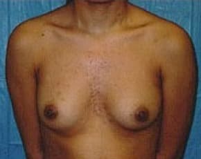 Breast Augmentation Before & After Photos | Associates in Plastic Surgery