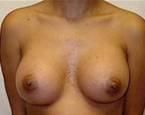 Breast Augmentation Before & After Photos | Associates in Plastic Surgery