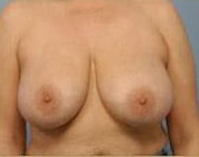 Breast Lift And Reduction Before & After Photos | Associates in Plastic Surgery