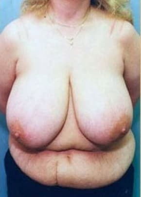 Breast Lift And Reduction Before & After Photos | Associates in Plastic Surgery