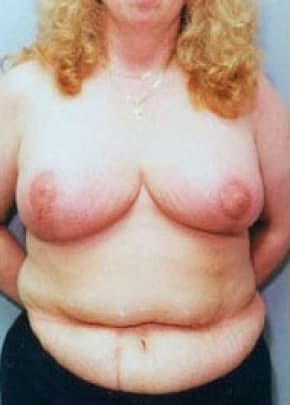 Breast Lift And Reduction Before & After Photos | Associates in Plastic Surgery