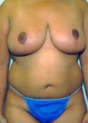 Breast Lift And Reduction Before & After Photos | Associates in Plastic Surgery