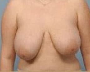 Breast Lift And Reduction Before & After Photos | Associates in Plastic Surgery
