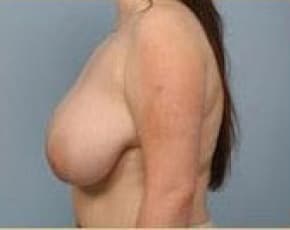 Breast Lift And Reduction Before & After Photos | Associates in Plastic Surgery