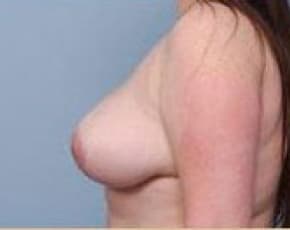 Breast Lift And Reduction Before & After Photos | Associates in Plastic Surgery