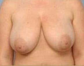 Breast Lift And Reduction Before & After Photos | Associates in Plastic Surgery