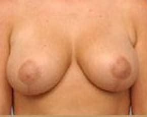 Breast Lift And Reduction Before & After Photos | Associates in Plastic Surgery