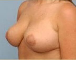 Breast Lift And Reduction Before & After Photos | Associates in Plastic Surgery
