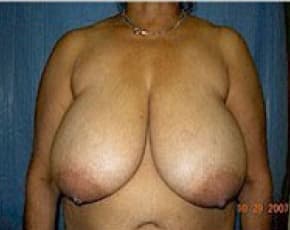 Breast Lift And Reduction Before & After Photos | Associates in Plastic Surgery