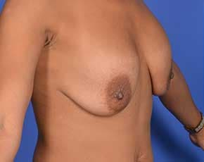 Breast Lift With Implants Before & After Photos | Associates in Plastic Surgery