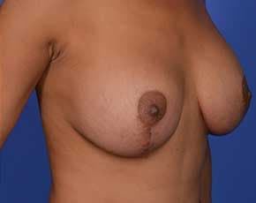 Breast Lift With Implants Before & After Photos | Associates in Plastic Surgery