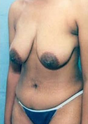 Breast Lift With Implants Before & After Photos | Associates in Plastic Surgery