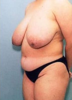 Breast Lift With Implants Before & After Photos | Associates in Plastic Surgery