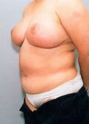 Breast Lift With Implants Before & After Photos | Associates in Plastic Surgery