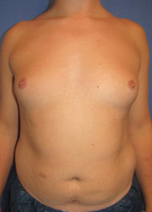 Male Breast Reduction Before & After Photos | Associates in Plastic Surgery