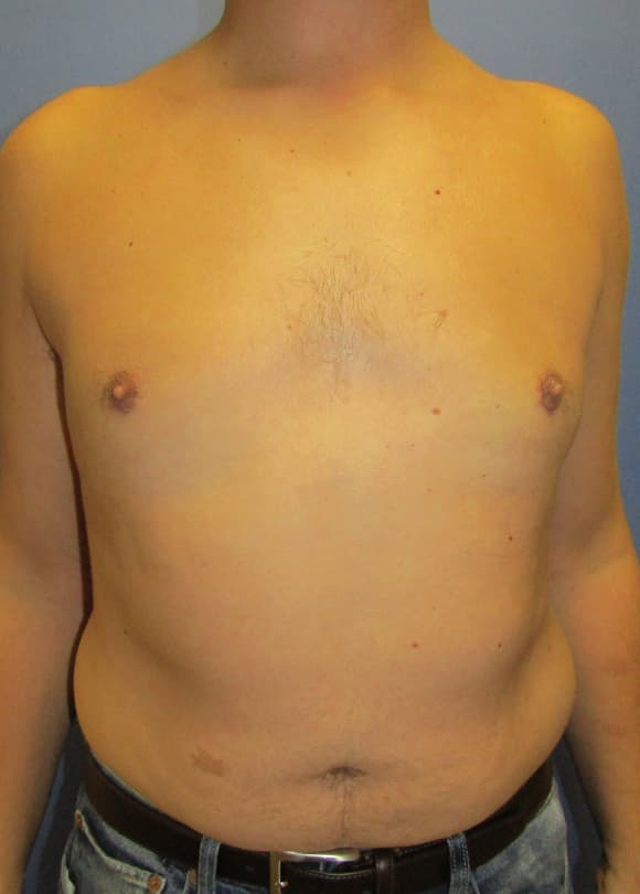 Male Breast Reduction Before & After Photos | Associates in Plastic Surgery