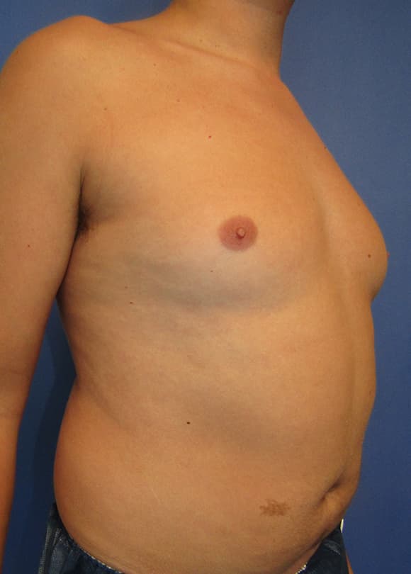 Male Breast Reduction Before & After Photos | Associates in Plastic Surgery