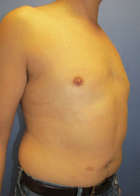 Male Breast Reduction Before & After Photos | Associates in Plastic Surgery