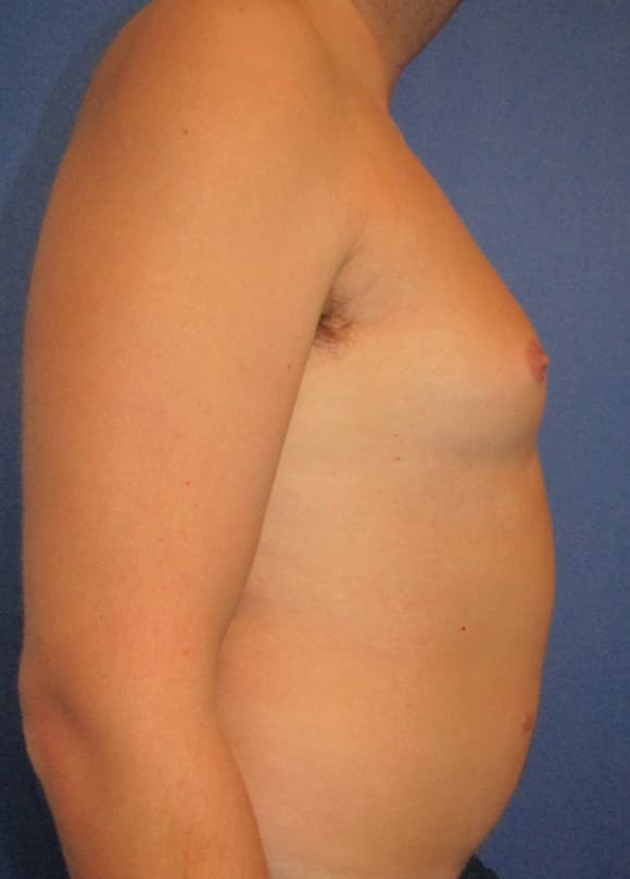 Male Breast Reduction Before & After Photos | Associates in Plastic Surgery