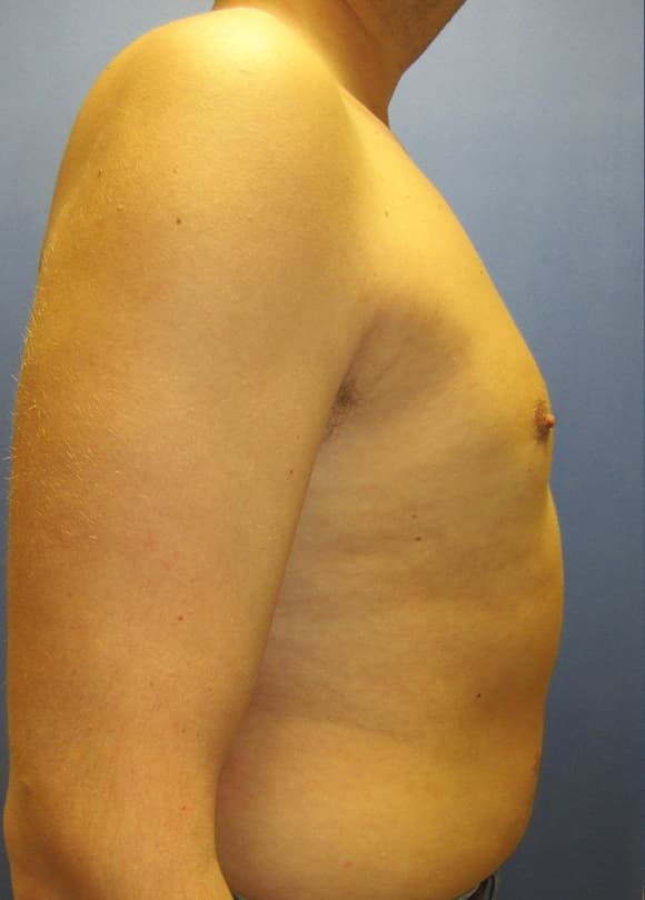 Male Breast Reduction Before & After Photos | Associates in Plastic Surgery