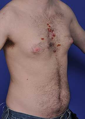 Male Breast Reduction Before & After Photos | Associates in Plastic Surgery
