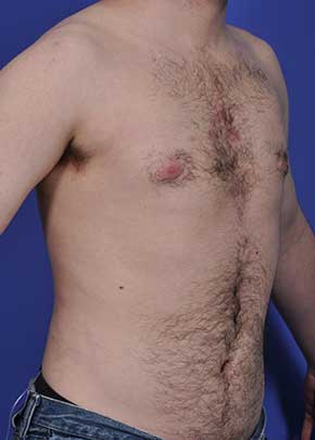 Male Breast Reduction Before & After Photos | Associates in Plastic Surgery
