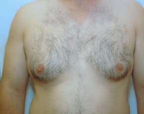 Male Breast Reduction Before & After Photos | Associates in Plastic Surgery