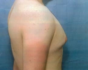 Male Breast Reduction Before & After Photos | Associates in Plastic Surgery