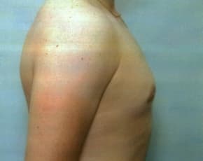 Male Breast Reduction Before & After Photos | Associates in Plastic Surgery