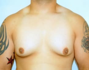 Male Breast Reduction Before & After Photos | Associates in Plastic Surgery