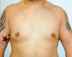 Male Breast Reduction Before & After Photos | Associates in Plastic Surgery