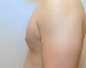 Male Breast Reduction Before & After Photos | Associates in Plastic Surgery