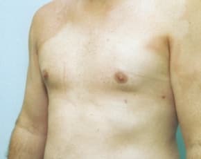 Male Breast Reduction Before & After Photos | Associates in Plastic Surgery