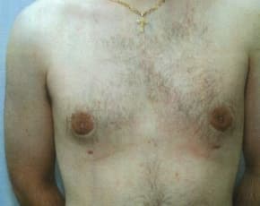 Male Breast Reduction Before & After Photos | Associates in Plastic Surgery