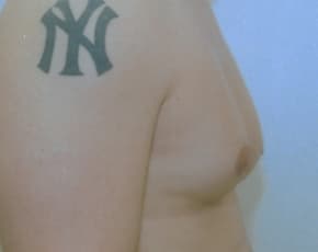Male Breast Reduction Before & After Photos | Associates in Plastic Surgery