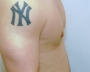 Male Breast Reduction Before & After Photos | Associates in Plastic Surgery